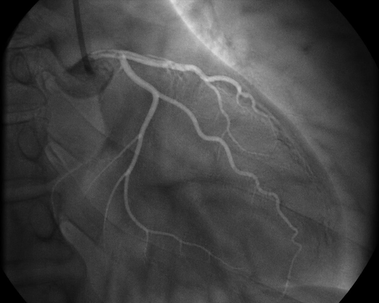 Simulated fluoroscopic coronary angiogram frame with contrast-filled arteries